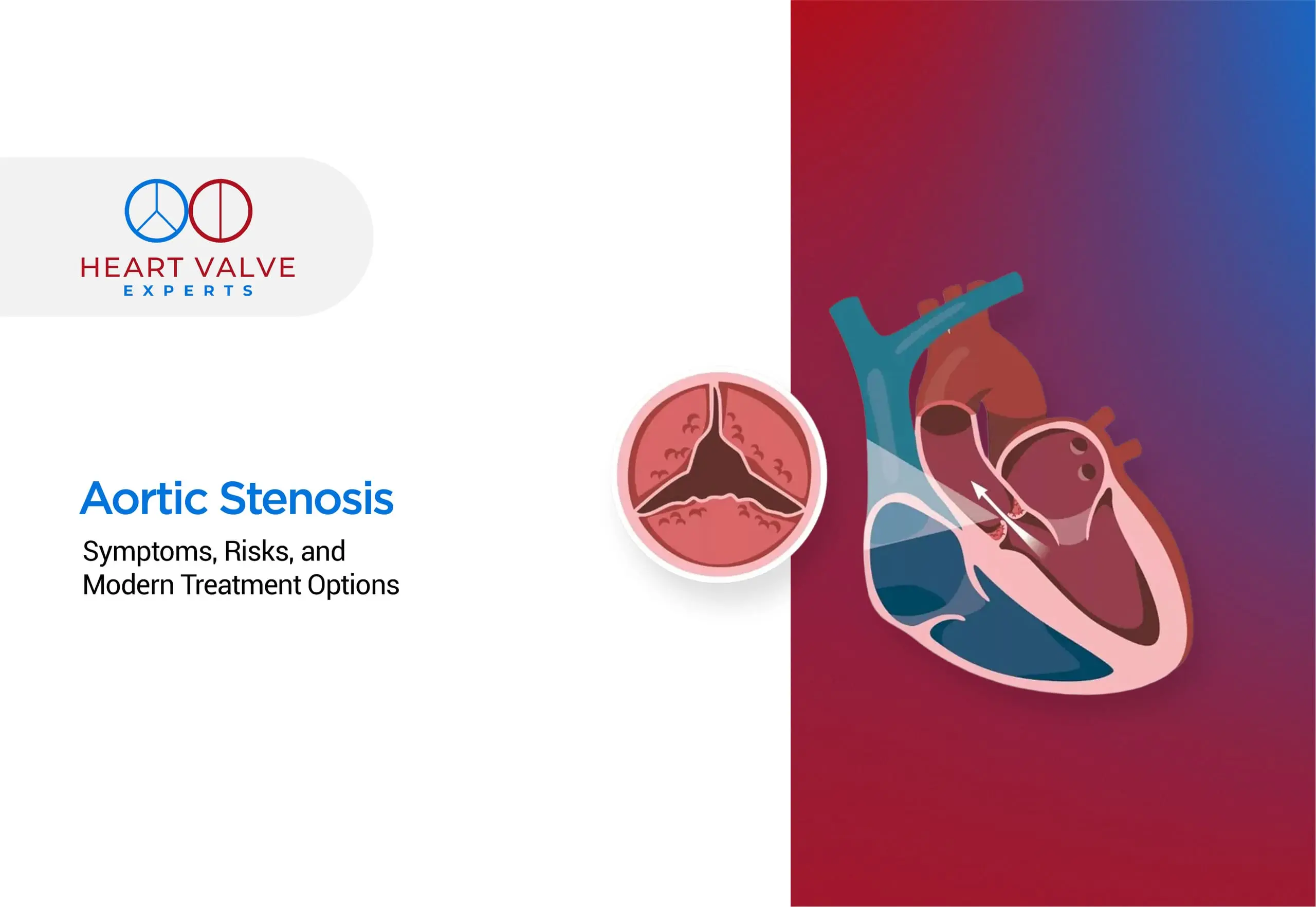Aortic Stenosis: Symptoms, Risks, and Modern Treatment Options