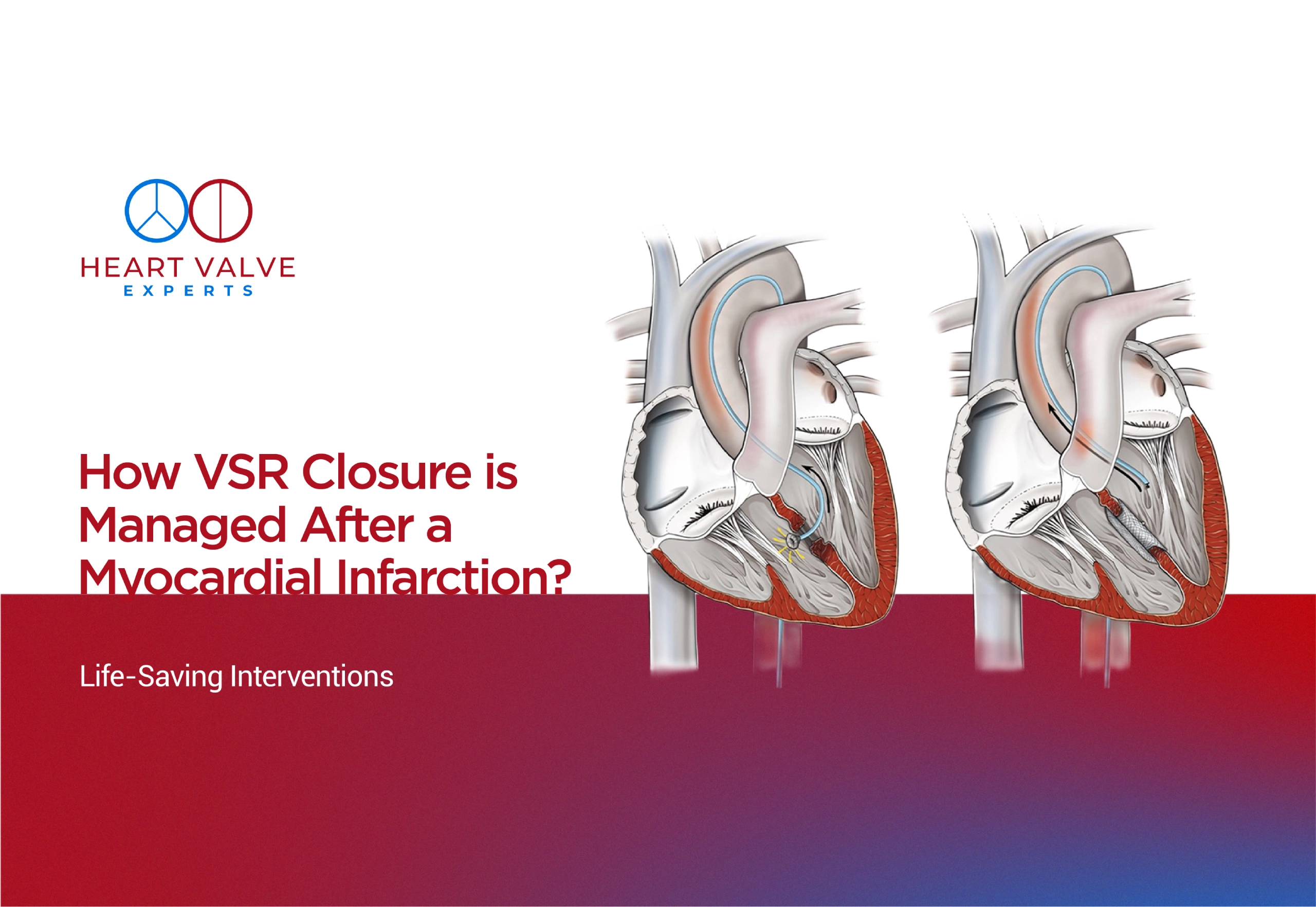 How VSR Closure Is Managed After a Myocardial Infarction? Life-Saving Interventions